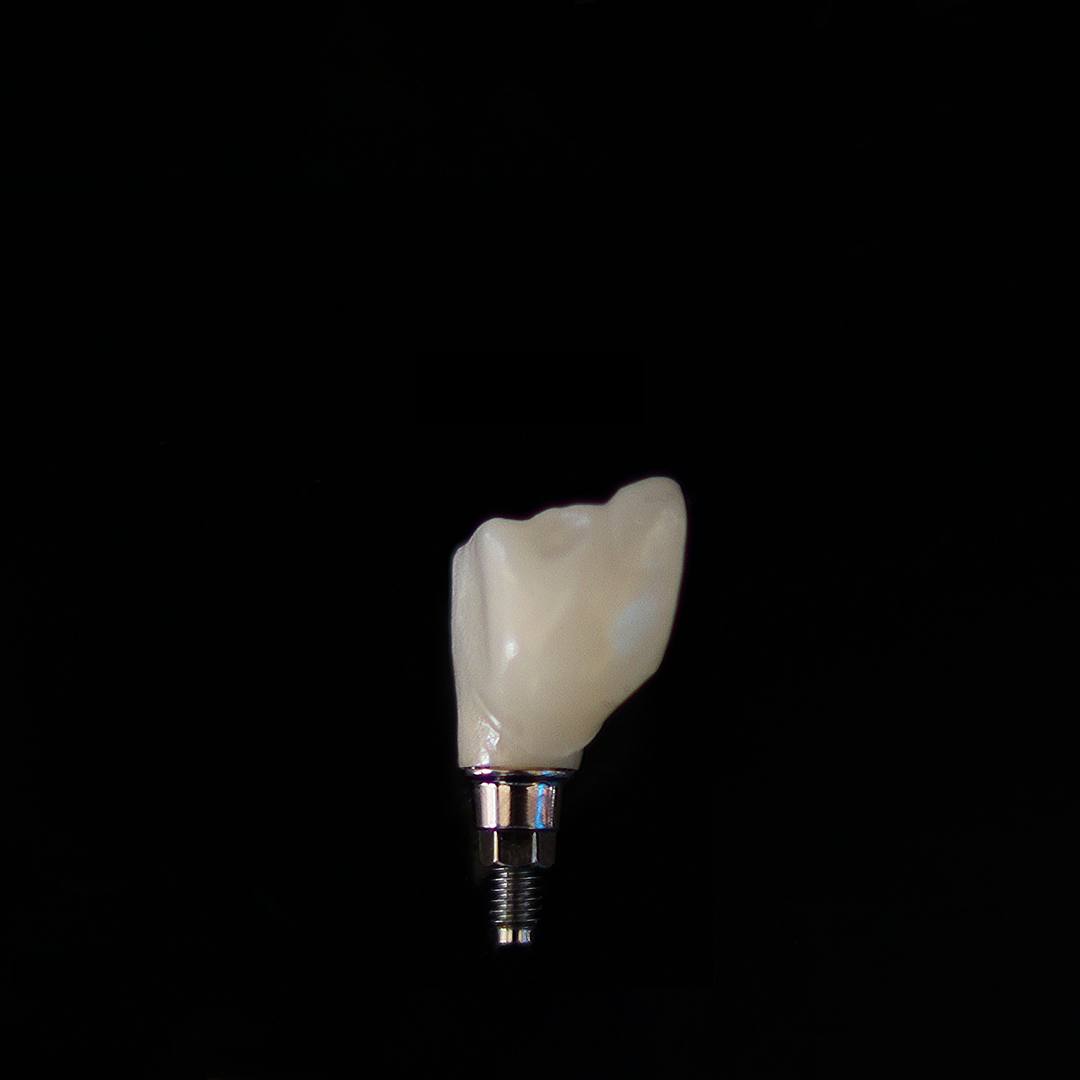 Una corona avvitata sul suo impianto, su fondo nero