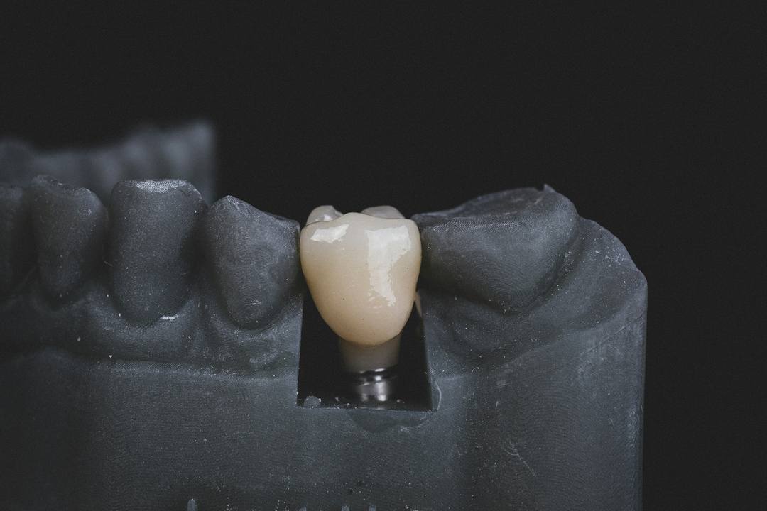 Una corona in ceramica sul moncone di un modello scuro