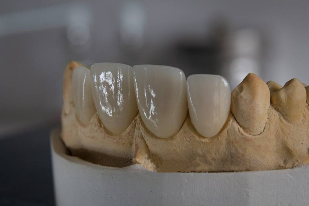 Quattro corone anteriori in ceramica sul modello in gesso