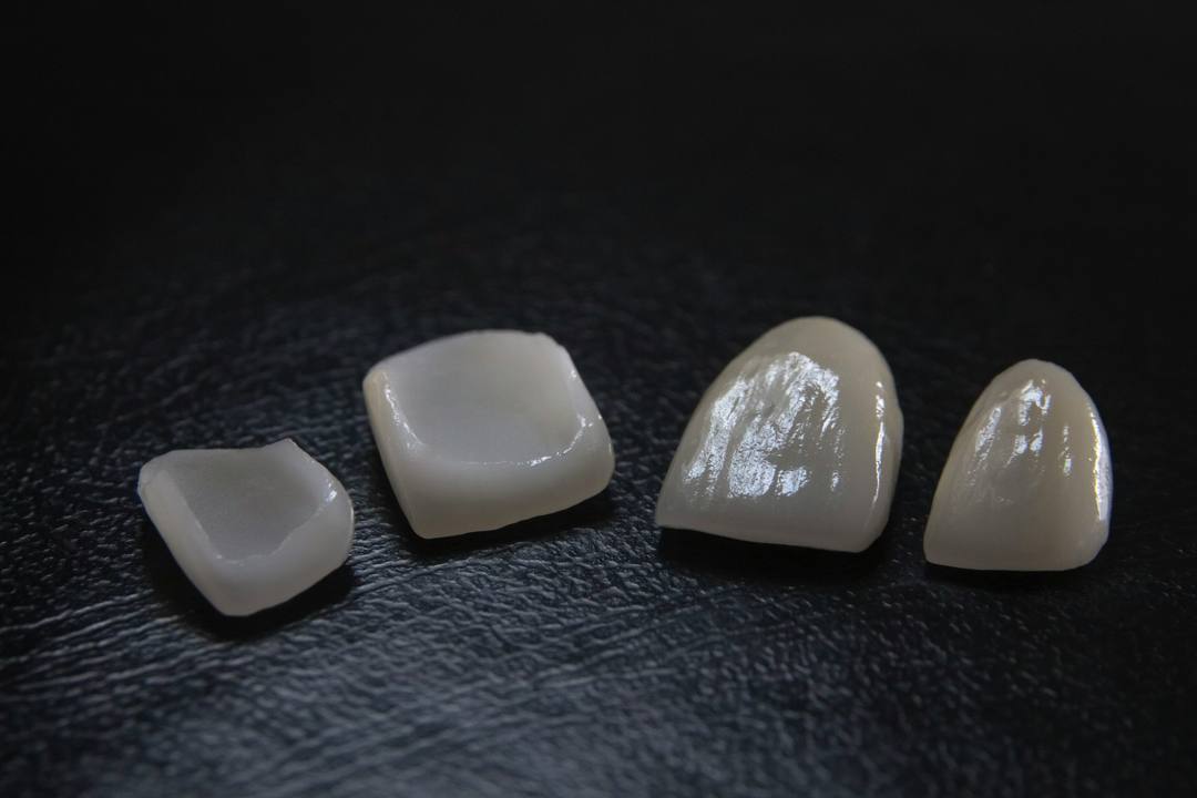 Quattro faccette in ceramica allineate su un piano scuro