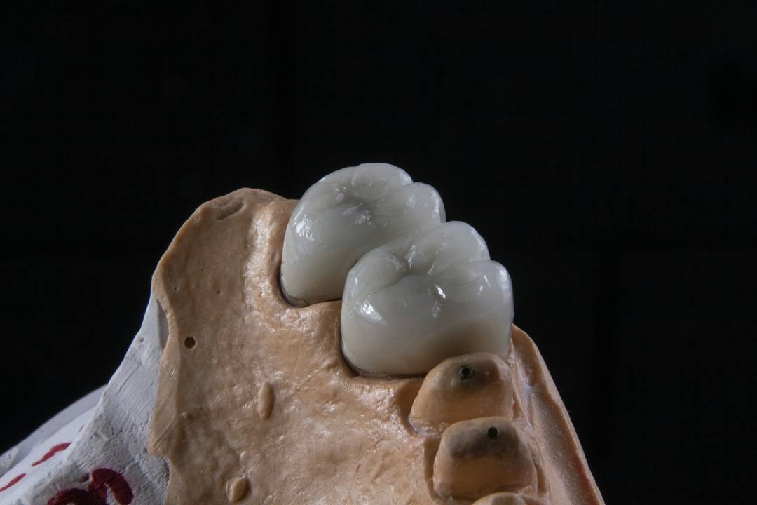 Un ponte posteriore in ceramica sul modello in gesso