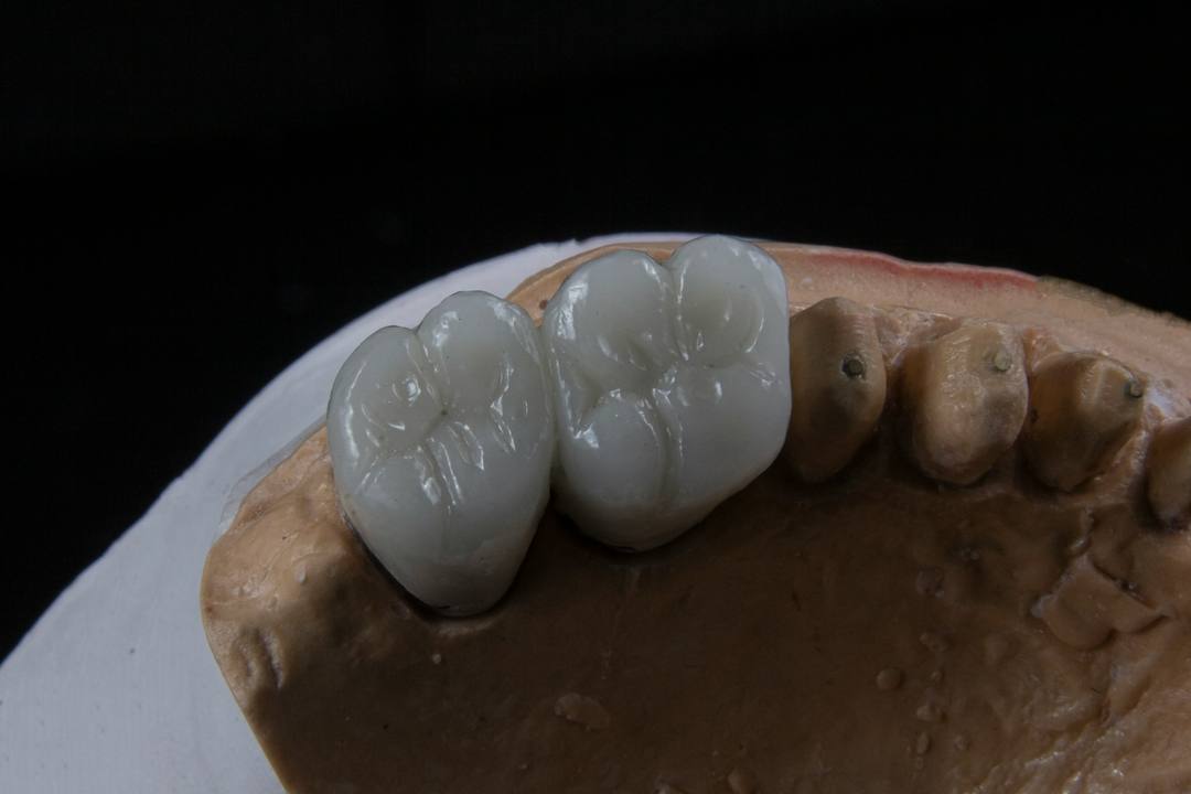 Un ponte di due molari in zirconia sul modello in gesso