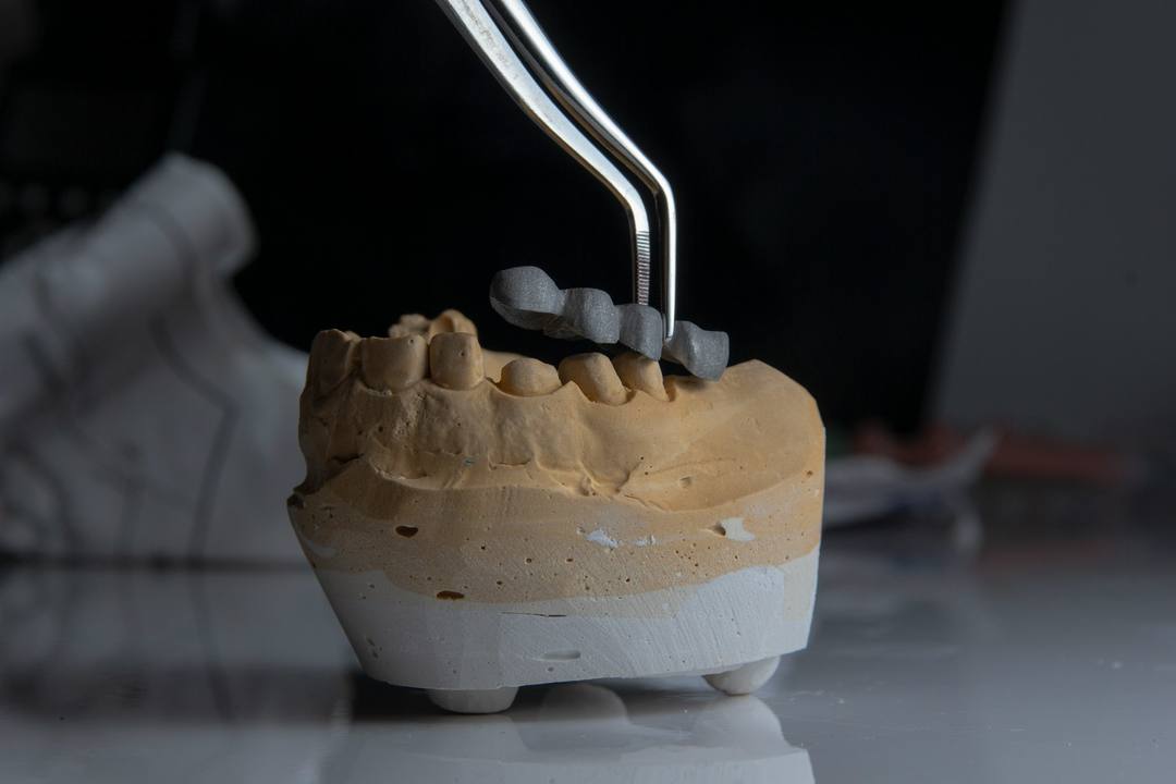 Con la pinzetta, una struttura in metallo per un ponte posata sul modello in gesso